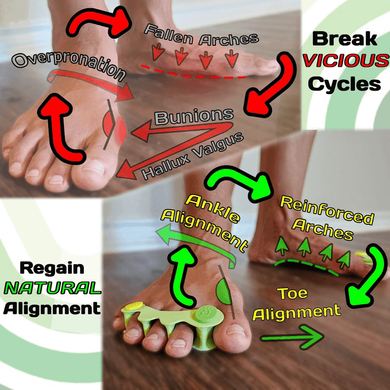Toe Spreaders by Allways barefoot - Combat Bunions & Strengthen Arches - View 5